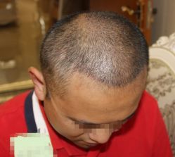 -大麦微针植发丨全国连锁