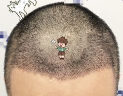 -大麦微针植发全国连锁