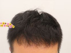 -大麦微针植发全国连锁
