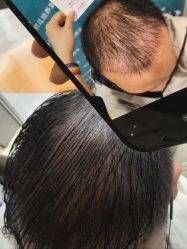 -碧莲盛·不剃发植发