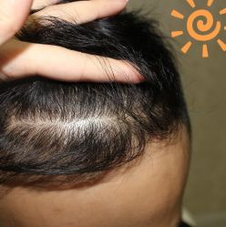 -大麦微针植发丨全国连锁