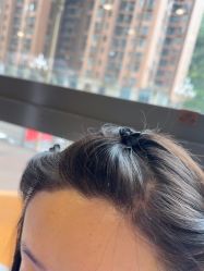 -碧莲盛·不剃发植发