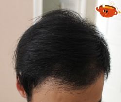 -大麦微针植发丨全国连锁