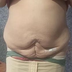 体验后-华美整形美容医院