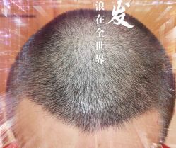 -大麦微针植发全国连锁