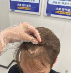 -大麦微针植发全国连锁