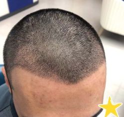 -大麦微针植发丨全国连锁