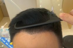 -大麦微针植发丨全国连锁