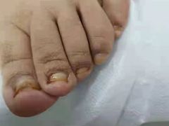 -世龙世家灰指甲鸡眼脚气甲沟炎跖疣护理(通州店)