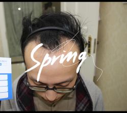 点击看大图 -大麦微针植发全国连锁