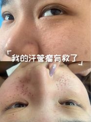 -美丽人生祛斑扁平疣汗管瘤中心