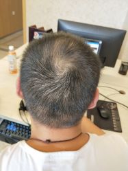 点击看大图 -大麦微针植发丨全国连锁