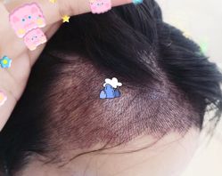 -大麦微针植发全国连锁