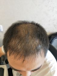 点击看大图 -大麦微针植发丨全国连锁