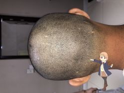 -大麦微针植发丨全国连锁