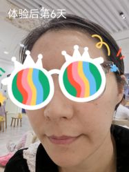 体验后-南宁维密整形·王敦华眼鼻整复中心