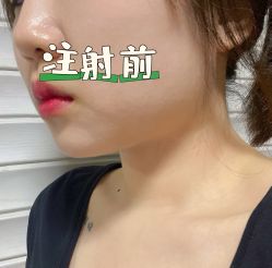 体验前-苏州维多利亚美容医院
