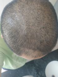 -大麦微针植发全国连锁