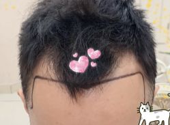 -大麦微针植发全国连锁