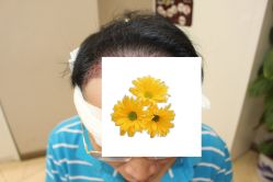-大麦微针植发丨全国连锁