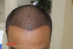 -大麦微针植发丨全国连锁