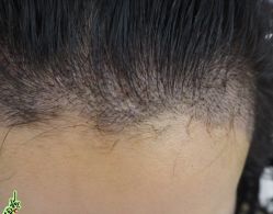 -大麦微针植发丨全国连锁