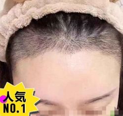 -大麦微针植发丨全国连锁
