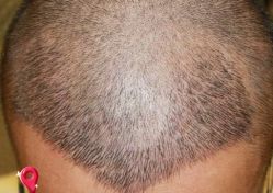 -大麦微针植发丨全国连锁