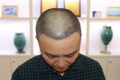 -大麦微针植发丨全国连锁