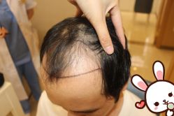 -大麦微针植发丨全国连锁