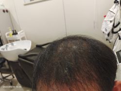 点击看大图 -碧莲盛·不剃发植发