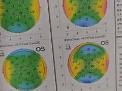 -成都新视界眼科医院·近视手术·儿童近视