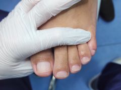 -Andrew指甲专科灰指甲·甲沟炎矫正·3D步态矫形鞋垫定制(浦三路店)