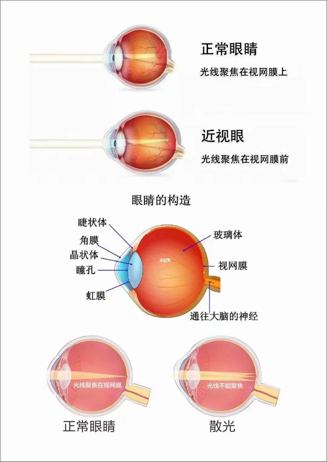 n首先,我们需要知道的是,近视是由于「眼球变长」,导致正常屈光铣统