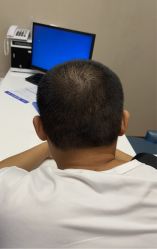 体验后-大麦微针植发全国连锁