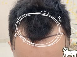 -大麦微针植发全国连锁