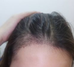 -大麦微针植发丨全国连锁