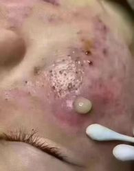 -苗方清颜专业祛痘连锁机构