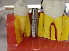 -上海仁爱医院口腔科 · 种植