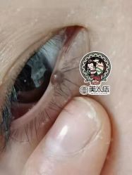-美人痣全国连锁