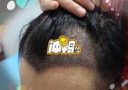 -大麦微针植发全国连锁