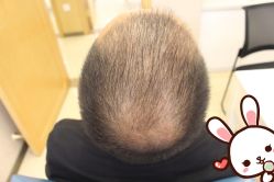 -大麦微针植发丨全国连锁