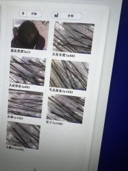 -大麦微针植发全国连锁