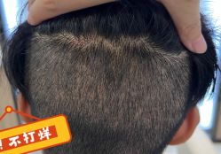 -大麦微针植发全国连锁