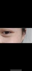 体验后-Yestar宁波艺星整形医院