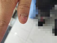 -Andrew指甲专科灰指甲·甲沟炎矫正·3D步态矫形鞋垫定制(浦三路店)