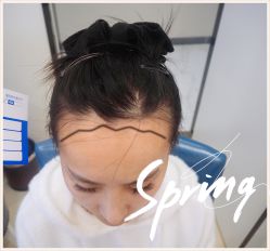 体验后-大麦微针植发全国连锁