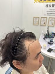 -大麦微针植发全国连锁