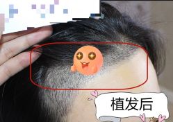 -大麦微针植发全国连锁