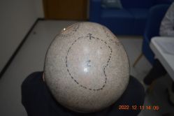 -大麦微针植发全国连锁